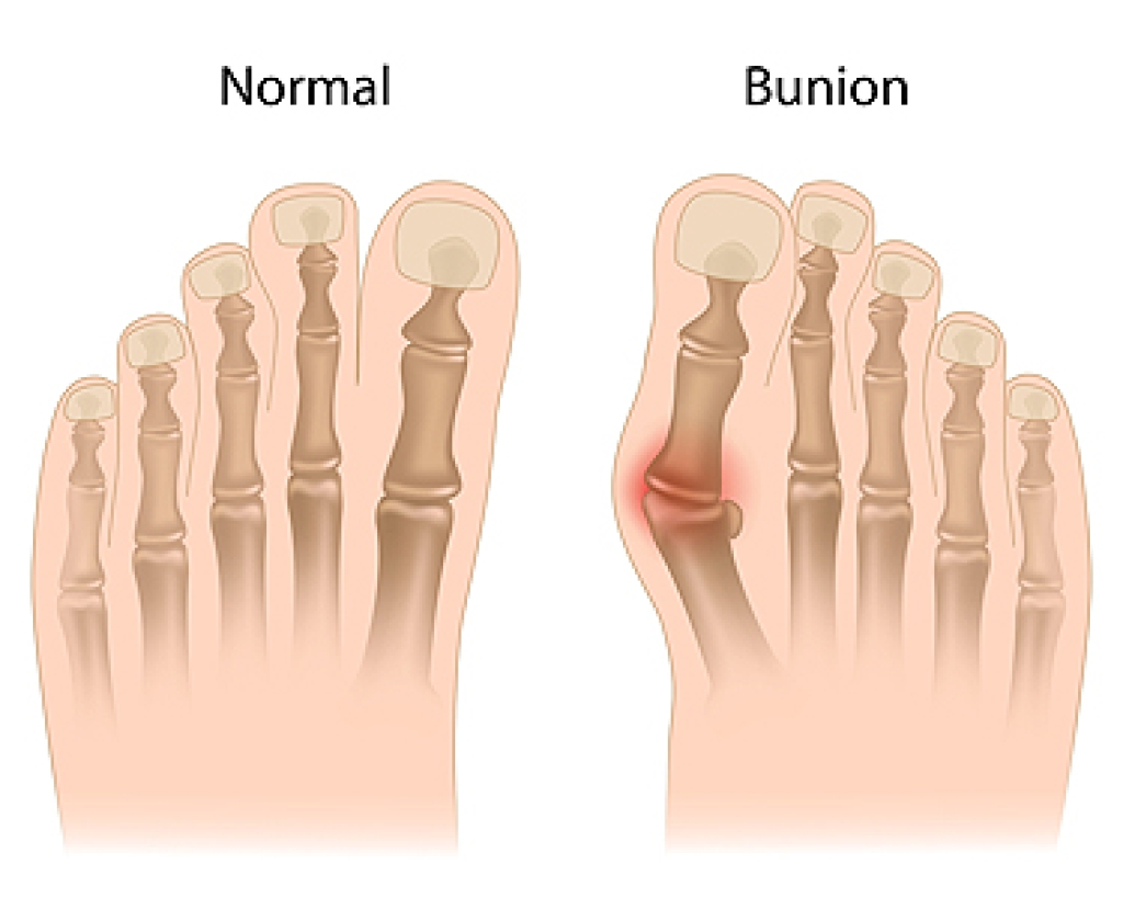 How Bunions Develop and Impact Daily Movement