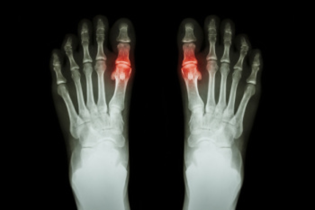 Gout and Podiatric Care