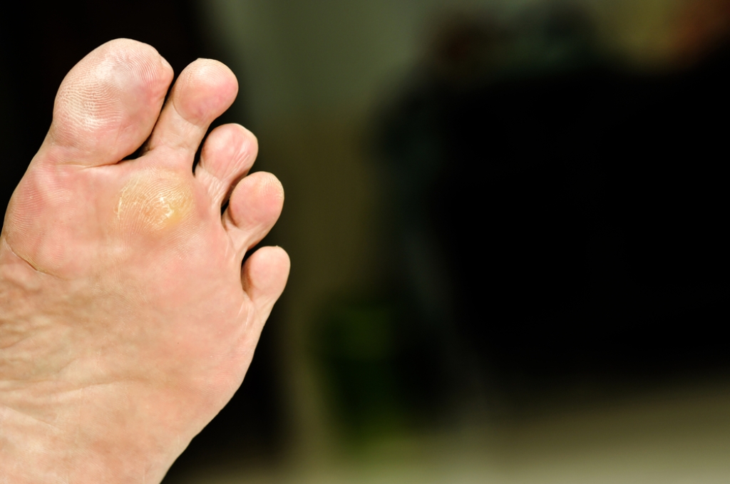 Causes and Risks of Plantar Warts