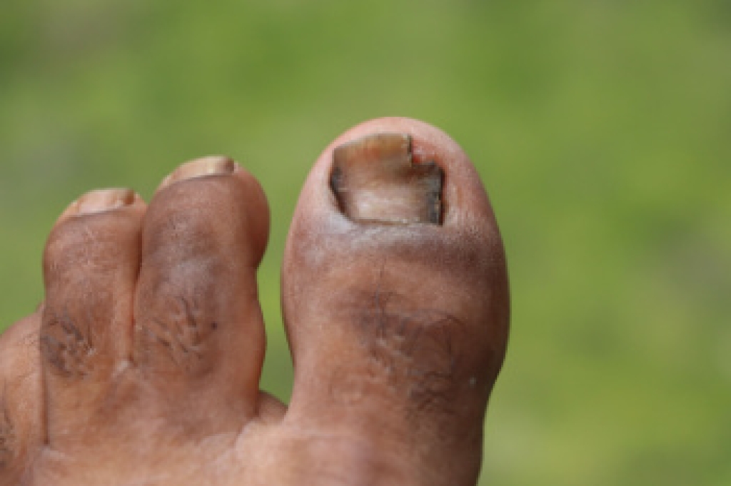 Toenails That Become Thick and Difficult to Manage