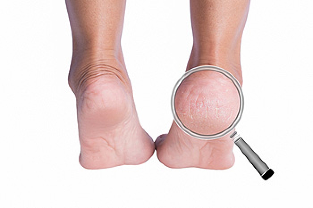 Podiatric Treatment for Cracked Heels