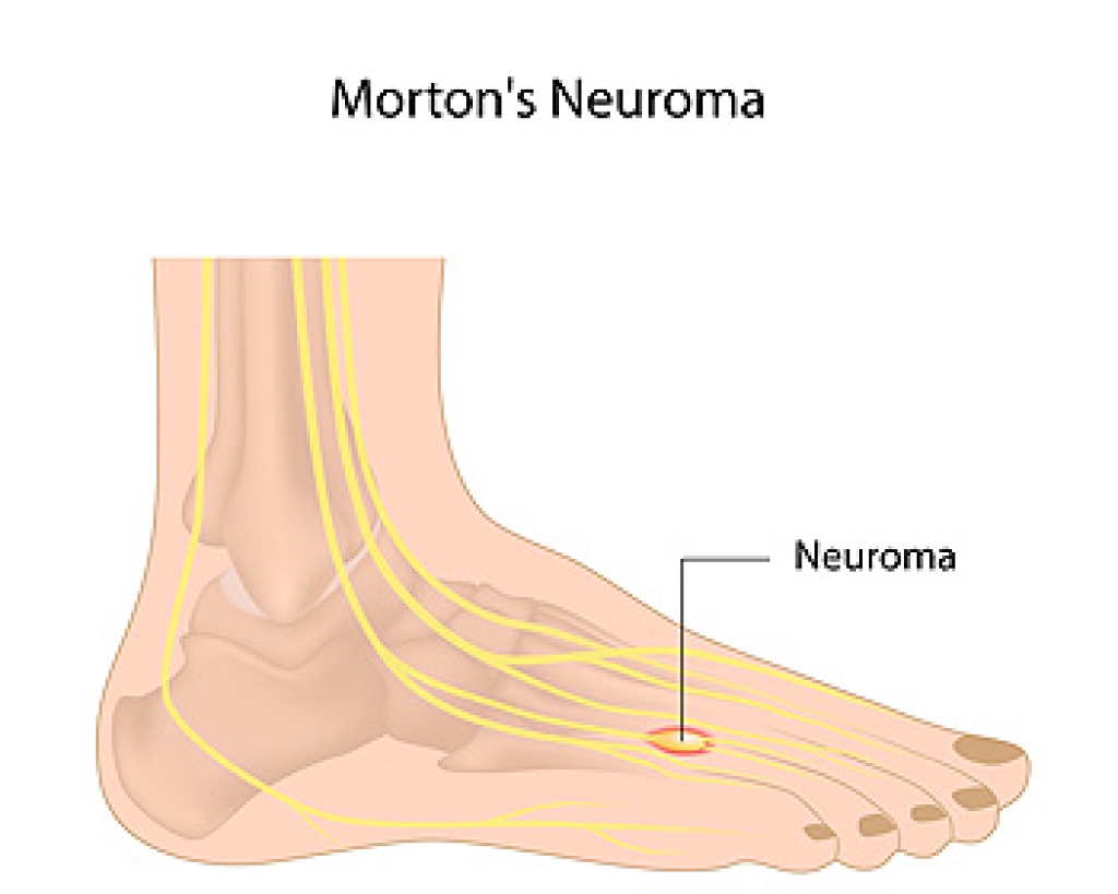 Indication of Morton’s Neuroma