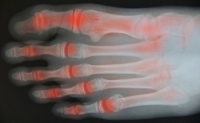 Arthritis in the Toes