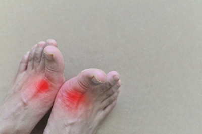 Managing Episodes of Gout