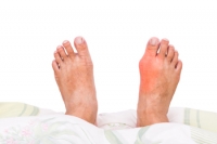 Arthritis and Gout