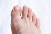 Are Ingrown Toenails Painful?